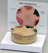 Skin Cancer Model Pharmaceutical and Anatomical Model Gifts